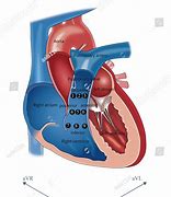 Image result for Right Ventricular Outflow Tract