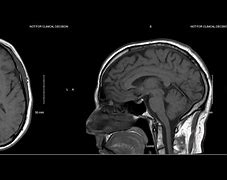 Image result for Abnormal Brain MRI without Contrast