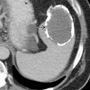 Image result for Cyst On Spleen