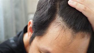 Image result for Low Dose Minoxidil for Hair Loss