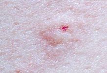 Image result for Bug Bites and Stings