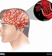 Image result for Brain Cancer Photo Human