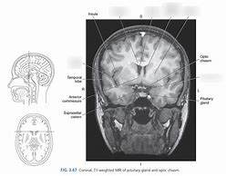 Image result for Coronal Plane Brain MRI