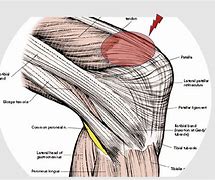 Image result for Quadriceps Tendon Atrophy