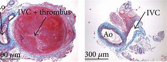 Image result for IVC Thrombs Post-Mortem