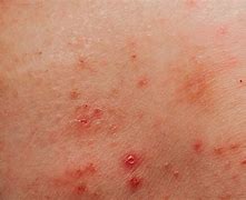 Image result for Herpes Genitalis