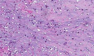 Image result for Cardiac Myxoma