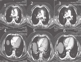 Image result for Angio CT Scan