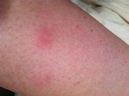 Image result for Red Flat Skin Lesion