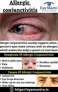 Image result for Allergic Conjunctivitis Treatment