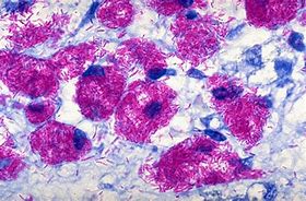 Image result for Mycobacterium Avium Infection