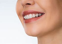 Image result for Fixed Braces Teeth Side View