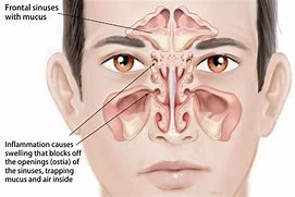 Image result for Sinus and Ear Pressure