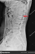 Image result for Imagees Compression Fracture of Lumbar Vertebrae