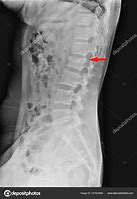 Image result for Lumbar Compression Burst Fractures