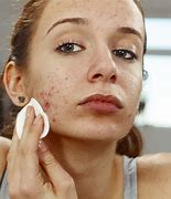 Image result for Face Mites Treatment