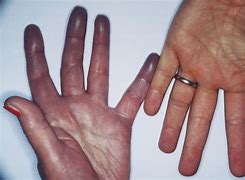 Image result for Cyanosis in Adults