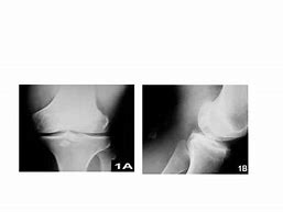 Image result for Posterior Knee Loose Bodies