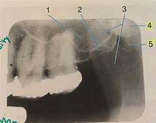 Image result for Pterygoid Plate