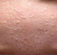 Image result for Swollen Face From Under the Skin Pimple