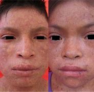 Image result for Atrophic Skin Aging