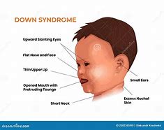 Image result for African American Trisomy 21