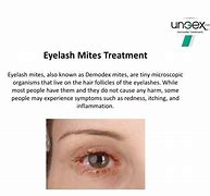 Image result for Treatment for Eyelash Mites