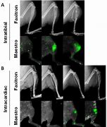 Image result for DDR and Bone Metastasis