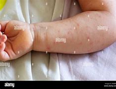 Image result for Eczema On Baby Arm