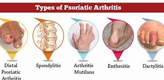 Image result for Psoriatic Arthritis On Face