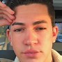 Image result for Acne Boy Face Map