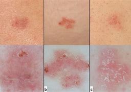 Image result for Red Flat Skin Lesion