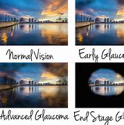 Image result for Double Glaucoma