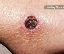 Image result for Widow Spider Bites Blue