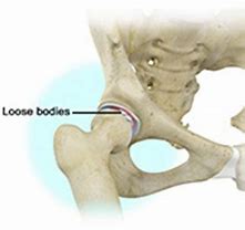 Image result for Posterior Knee Loose Bodies