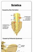 Image result for L3 L4 Sciatica