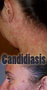 Image result for Candida Face