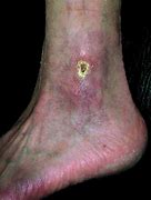 Image result for Thrombotic Veins