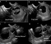 Image result for Anencephaly Ultrasound