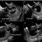 Image result for Anencephaly Ultrasound