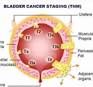 Image result for Gross Pathology Bladder Specimen