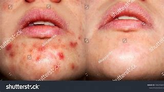 Image result for Acne Under Chin