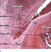 Image result for Thrombosis Histology