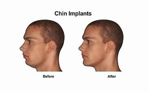 Image result for Pointy Chin Surgery