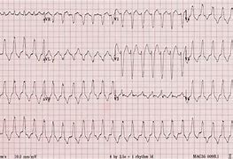 Image result for Right Ventricular Outflow Tract