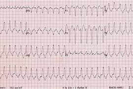 Image result for Right Ventricular Outflow Tract