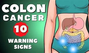 Image result for Colon Cancer Symptoms in Men Signs