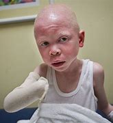 Image result for Child Boy Albino