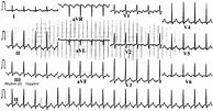 Image result for Permanent Junction Al Reciprocating Tachycardia