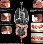 Image result for Human Body Colon Cancer